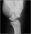 Secondary Signs Joint Effusion Secondary signs Joint effusion Lipohemarthrosis Gas in joint j ST