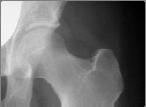 Fracture Femoral Neck Stress Fracture AP internal