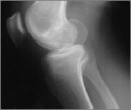 Femoral Condyle Fractures ACL Avulsion