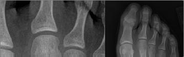 fracture Does ankle fracture suggest
