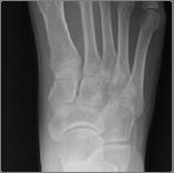 Fracture Dislocations Metatarsal Stress