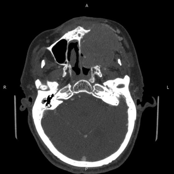 Figure 1. Axial CT image shows a large lesion occupying the entire left maxillary sinus with destruction of maxillary bone and involvement of the left nasal cavity.