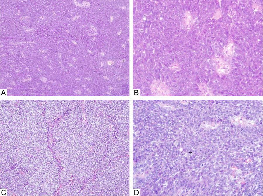 Figure 2. Histopathological findings. A. Low magnification shows anastomosing nests of tumor cells with basaloid features (hematoxylin-eosin, 100); B.