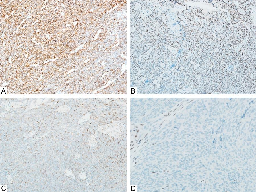Figure 3. Immunohistochemical findings. A. The neoplastic cells were diffusely immunoreactivity for CK AE1/AE3 ( 200); B.