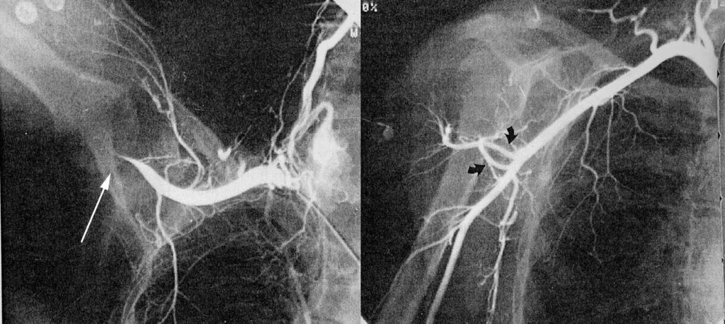 At angiography (humeral compression) collaterals