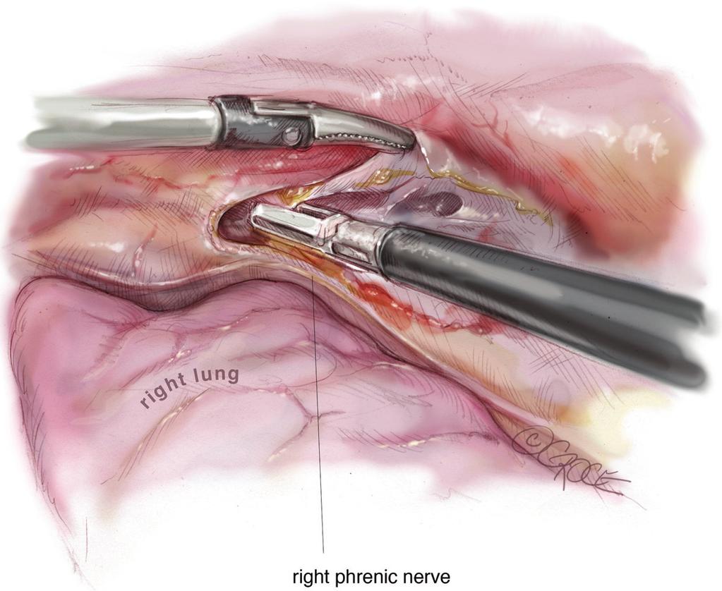Annals of cardiothoracic surgery, Vol 5, No 1 January 2016 53 Figure 4 On the right side, the right lower horn is dissected along the right phrenic nerve, the pericardium and sternum.