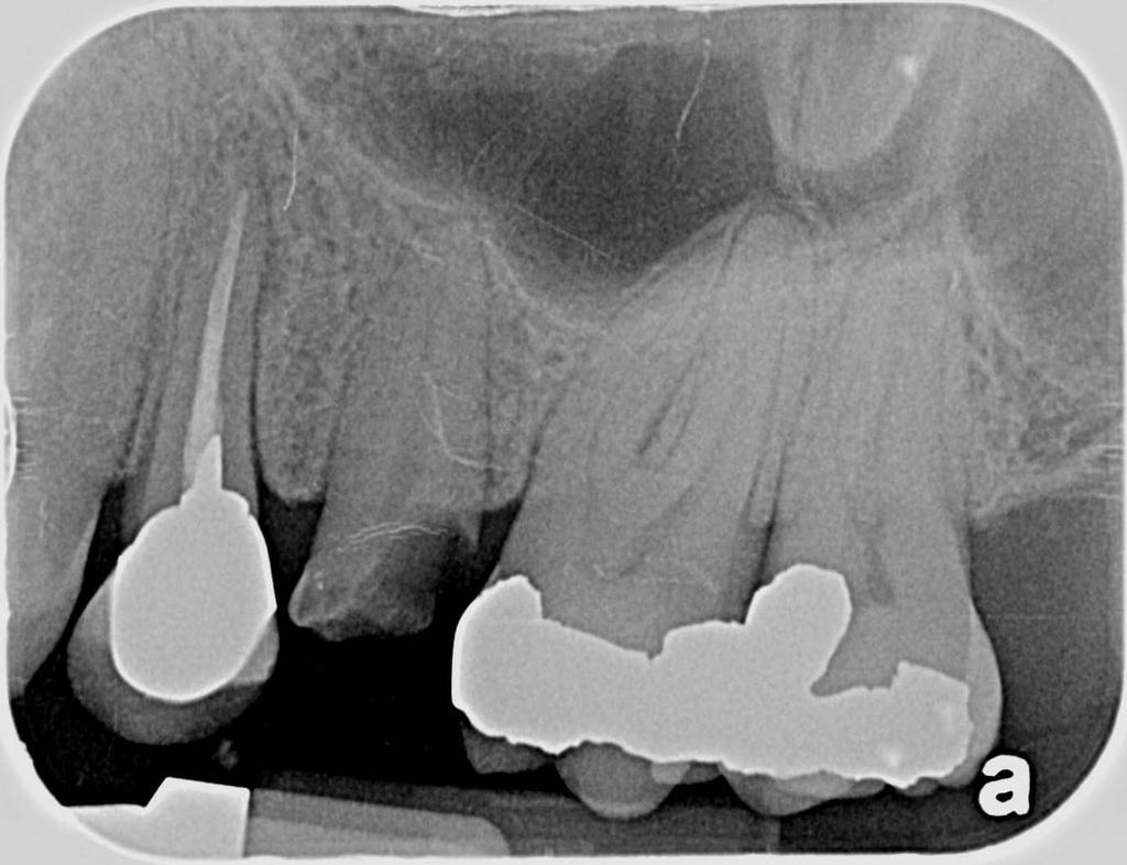 Anybody can see that tooth needs to go. Image of a broken tooth (center).