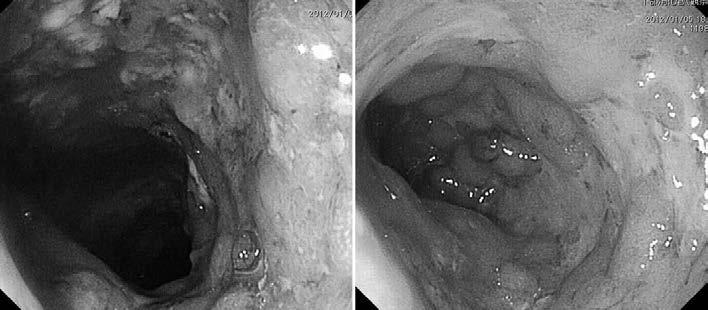 292 Takahiro UMEMOTO, et al A B Fig. 1. Colonoscopy Colonoscopy images showing severe mucosal edema A, and a tight stricture and longitudinal ulcers B in the rectum and sigmoid colon.
