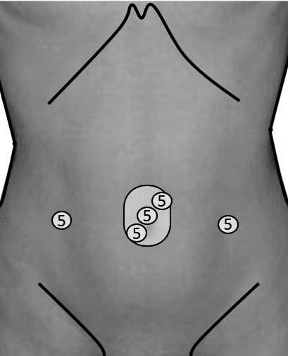 A 5 mm port was placed in the right right lower abdomen for the ileostomy site. Another 5 mm port was placed in the left right lower abdomen for the marked drain site.