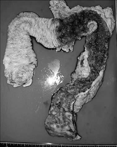 Resected specimen Photograph of the resected specimen, showing strictures, inflammation, and edema from the left-sided transverse colon to the rectum. margin of the symphysis pubis.