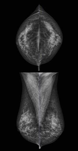 Fine-tuned digital breast imaging Ensuring the best possible image quality at the lowest