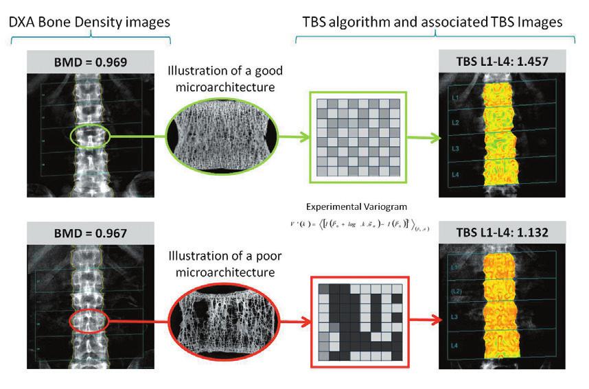 2 TBS insight: A New Tool to Identify Patients at Increased Risk of Fracture TBS insight is a software tool that installs on existing DXA scanners.