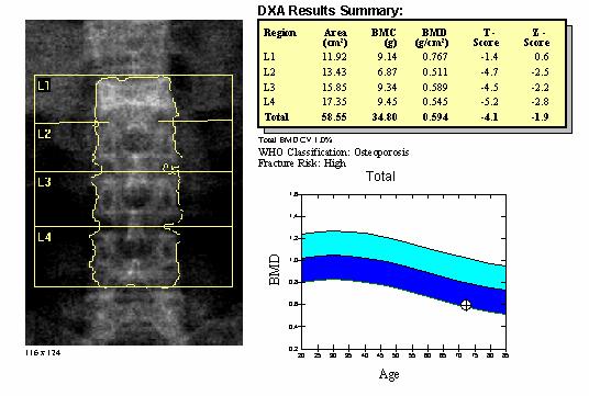 absorptiometry (DXA) Measure the BMD of lumbar spine ( L1-L4) and the hip (