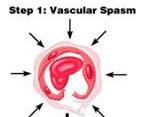 1. Vascular spasm Cause by: Direct injury (vasoconstriction