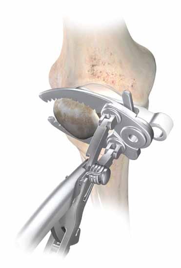 Patella Resection Tilt the patella to an angle of 40 to 60
