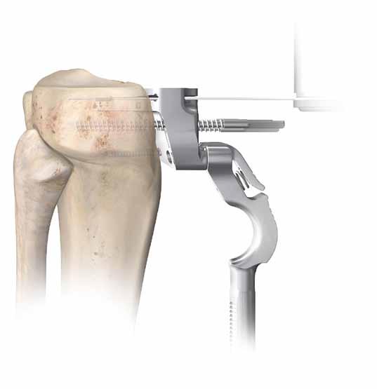 Tibial Resection Optional: The alignment tower may be introduced at this point into the two slots on the tibial cutting block.