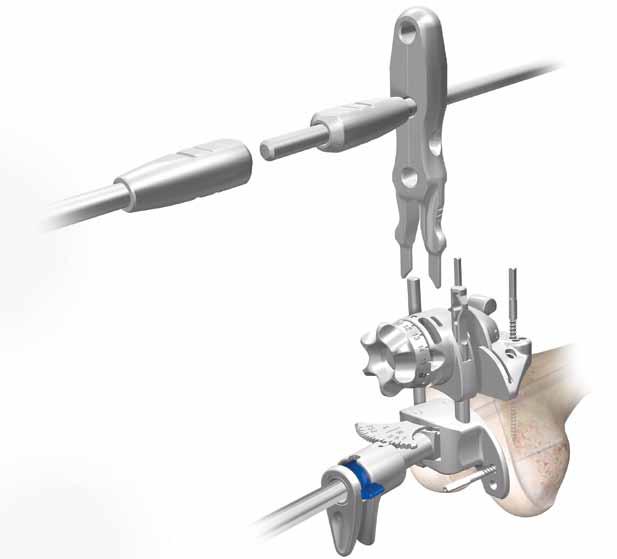 Femoral Alignment Distal femoral cutting block Position the resection guide over the two legs of the distal femoral alignment guide until the distal cutting block touches the anterior femur (Figure
