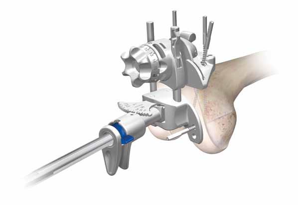 Distal Femoral Resection After the correct amount of resection is set, add a convergent pin through the medial hole in the block to aid stability (Figure 30). 1.