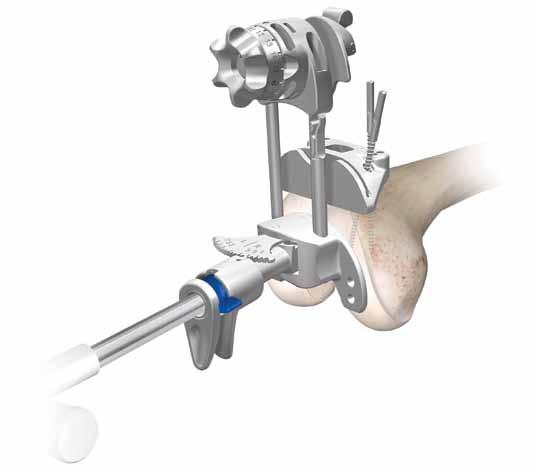 Slide the femoral resection guide upwards on the alignment guide legs until the block connector disengages the cutting block and in one motion remove the femoral alignment guide by pulling the