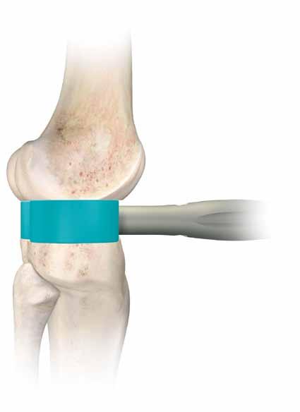 If the gap is not rectangular, the extension gap is not balanced and appropriate soft tissue balancing must