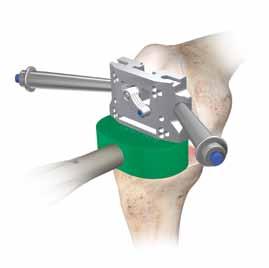 Femoral Rotation Two handles can be attached to the balanced cutting block to help in visualizing the degree of rotation of the balanced cutting block in respect to the transepicondylar axis (Figure