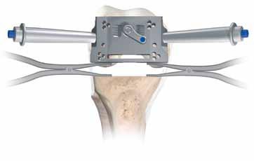 Introduce the femoral guide positioner, (with the appropriate tibial shim added) into the joint space engaging the posterior slot of the balanced resection guide (Figure 43).