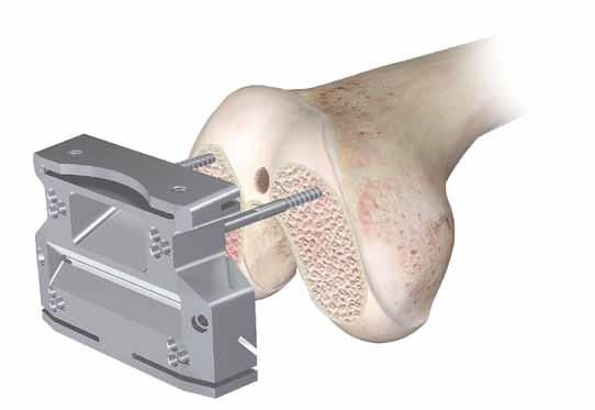 Femoral Preparation - A/P and Chamfer Cuts Remove the balanced femoral cutting block, leaving the pins in the distal femur.