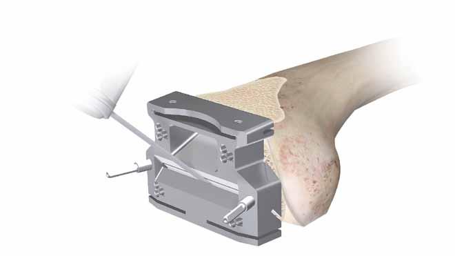 Note: The posterior saw captures are open medially and laterally to ensure completed saw
