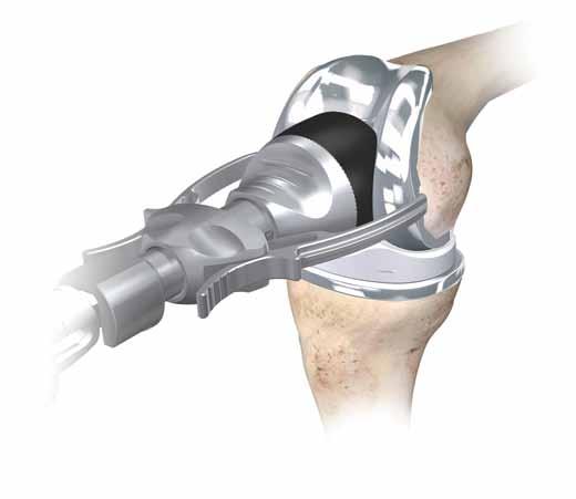 Final Component Implantation Locking knob Figure 74 Tibial Implantation Attach the M.B.T. tibial impactor by inserting the plastic cone into the implant and tighten by rotating the lock knob clockwise.
