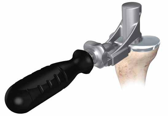 Figure 75 Femoral Implantation Hyperflex the femur and sublux the tibia forward. Attach the slap hammer or universal handle to the femoral inserter/extractor.