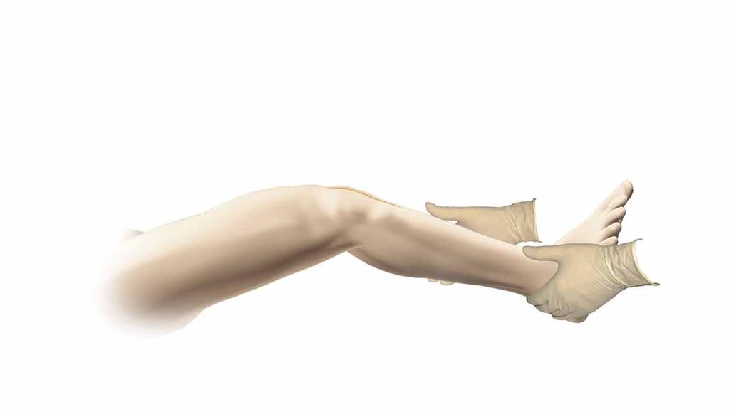 Closure Figure 78 Release the tourniquet and control bleeding by electrocautery. Place a closed-wound suction drain in the suprapatellar pouch and bring out through the lateral retinaculum.