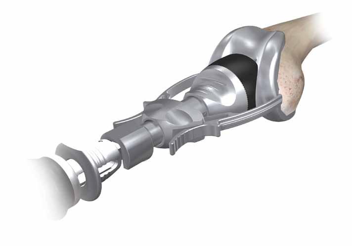 Appendix A: Fixed Bearing Modular Tibial Preparation Femoral Trial Attach the slap hammer or universal handle to the femoral inserter/extractor.