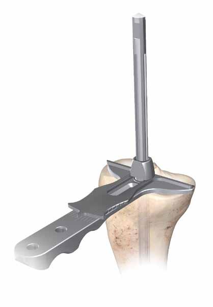 Appendix B: Tibial I.M. Jig Alignment Optional Remove the handle and place the I.M. rotation guide over the I.M. rod to define the correct rotational tibia axis, referring to the condylar axis, medial 1/3 of the tibia tubercle and the center of the ankle (Figure 91).