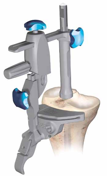Appendix B: Tibial I.M. Jig Alignment Slide the appropriate fixed or adjustable stylus in the HP tibial cutting block slot.