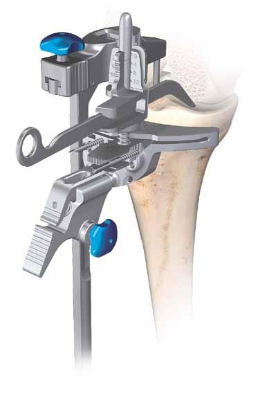 If the stylus is placed on the more damaged side of the tibial plateau, set the stylus to 0 mm or 2 mm.