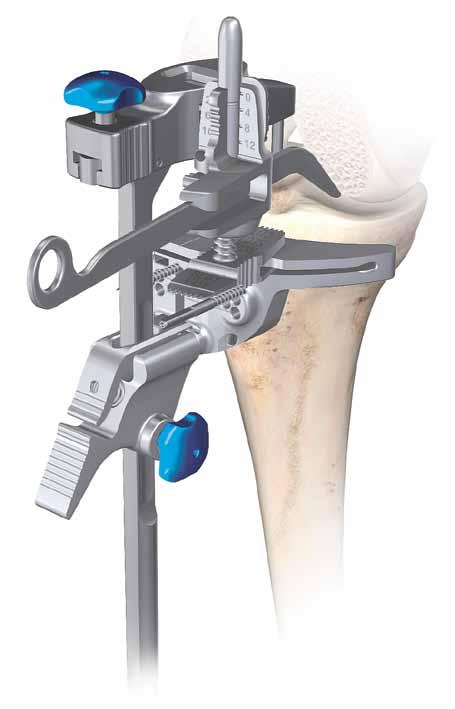 Non-slotted stylus foot If planning to resect through the slot, position the foot of the tibial stylus marked slotted into the slot of the tibial cutting block (Figure 99).