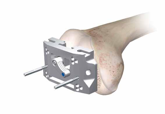 Position the appropriate Sigma or Sigma RP-F chamfer block in the pre-drilled medial and lateral holes.