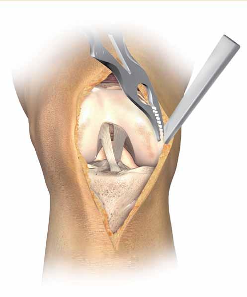 Incision and Exposure Excise hypertrophic synovium if present and a portion of the infrapatella fat pad to allow access to the medial, lateral and intercondylar spaces.