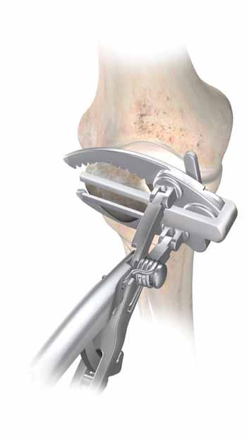 Figure 6 Select a patella stylus that matches the thickness of the implant to be used.