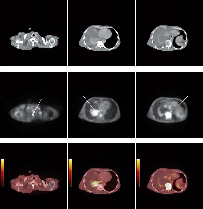 184 Avazpour I et al. / Segmenting CT images of bronchogenic carcinoma and PET Figure 2.