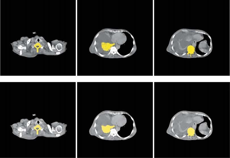 Avazpour I et al. / Segmenting CT images of bronchogenic carcinoma and PET 185 Figure 3. First row segmentation results and second row the desired ROI.