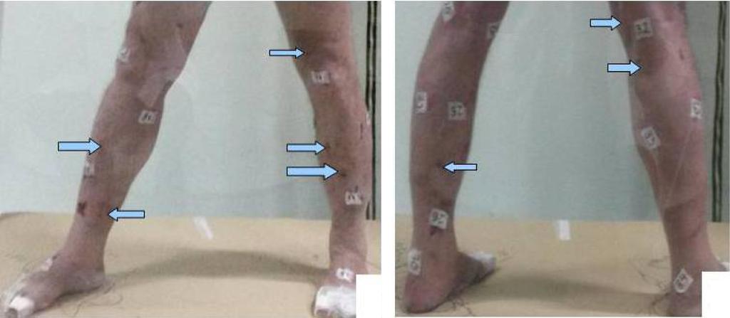 First hemi-body irradiation for Kaposi sarcoma 269 Case description history In March 2011 a 60-year-old patient developed a cutaneous lesion of 1.