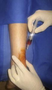 Other Nonoperative Treatments? Steroid injections? Risk of Achilles rupture!