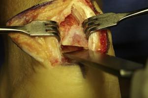 Surgical Treatment of Insertional