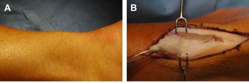 Surgical Treatment of Midsubstance Tendinopathy Debridement & repair Posteromedial incision Adjacent