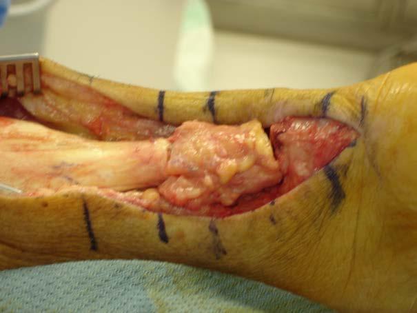 Complications Infection Wound
