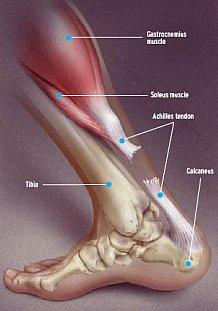 Etiology - Indirect Trauma Strong ankle dorsiflexion force with contraction of the gastrocnemius-soleus Strong ankle