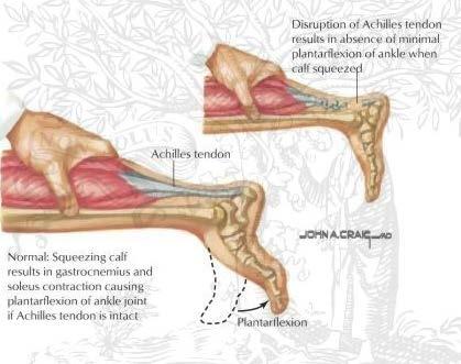 Physical Examination Decreased strength Palpable gap at tendon