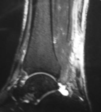 MRI US Further Imaging Gold standard for tendon visualization Useful for» Determining