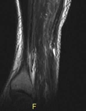 Myotendinous Achilles Ruptures Should be confirmed with MRI vs.